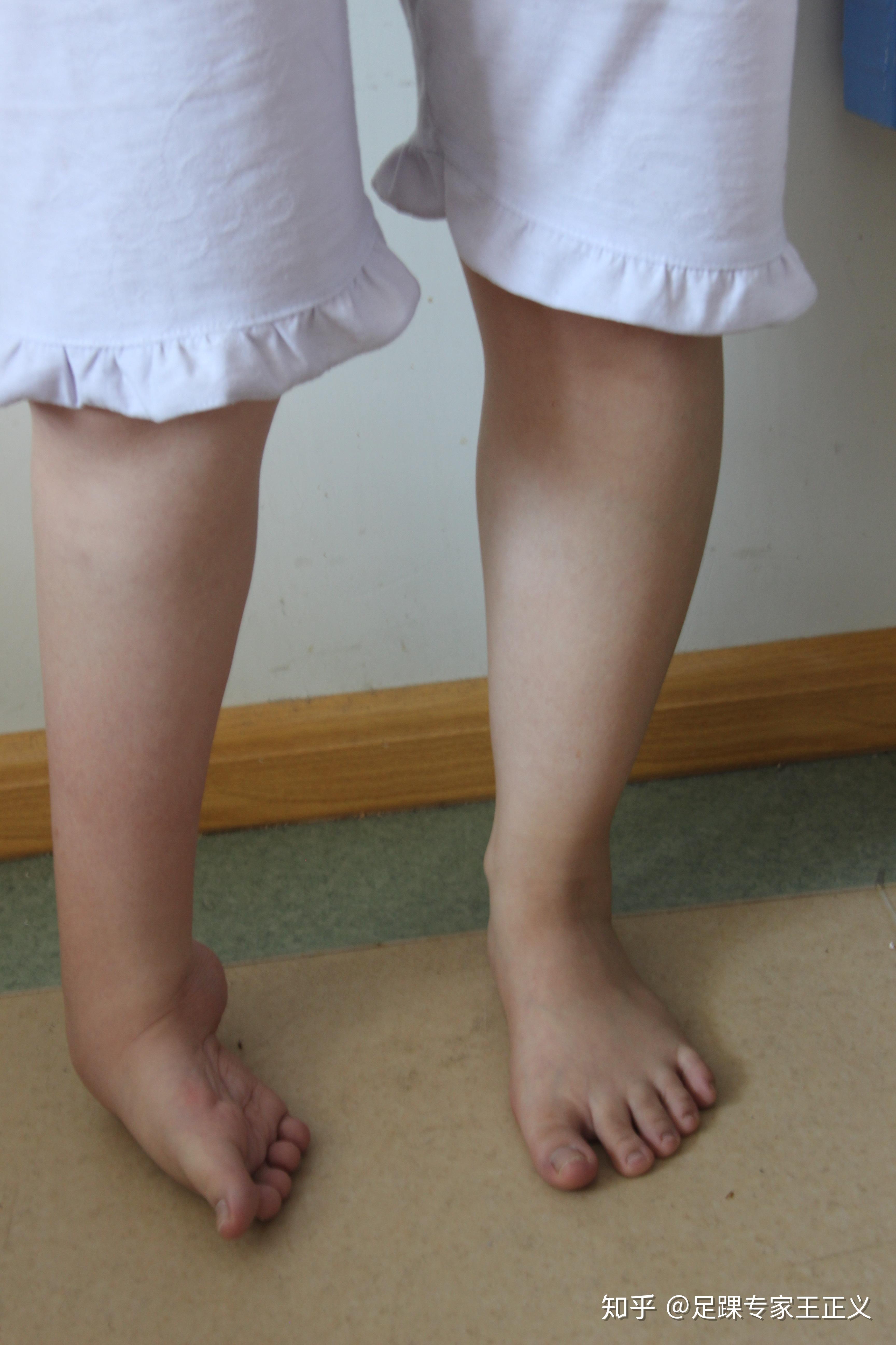 儿童踝关节正常图片图片