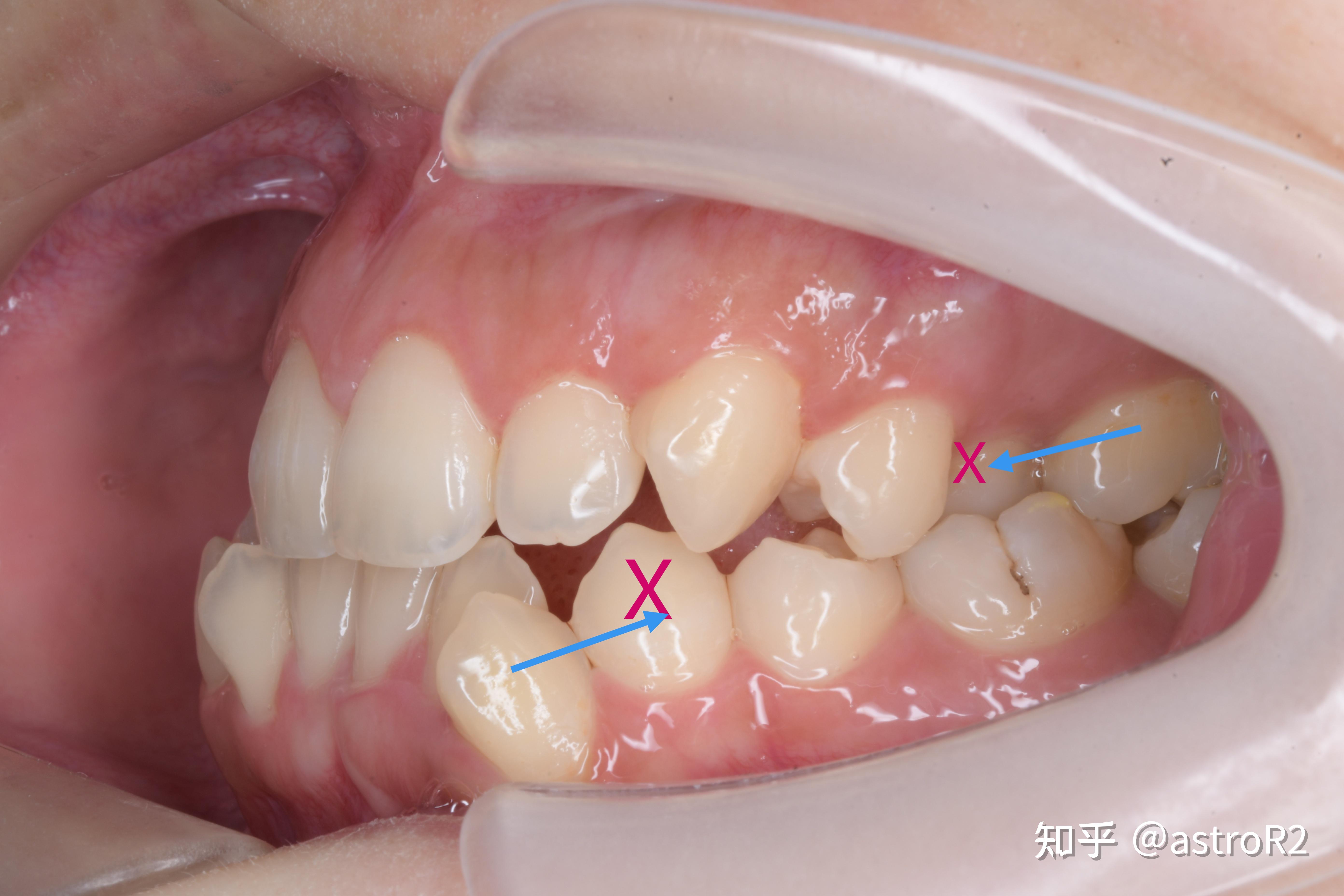 口腔/ 我和口腔科的故事(5): 北大口腔正畸篇-病歷中的基礎知識