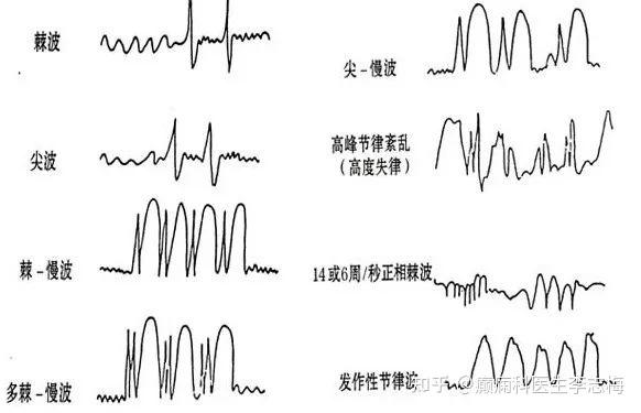 不正常脑电图图片