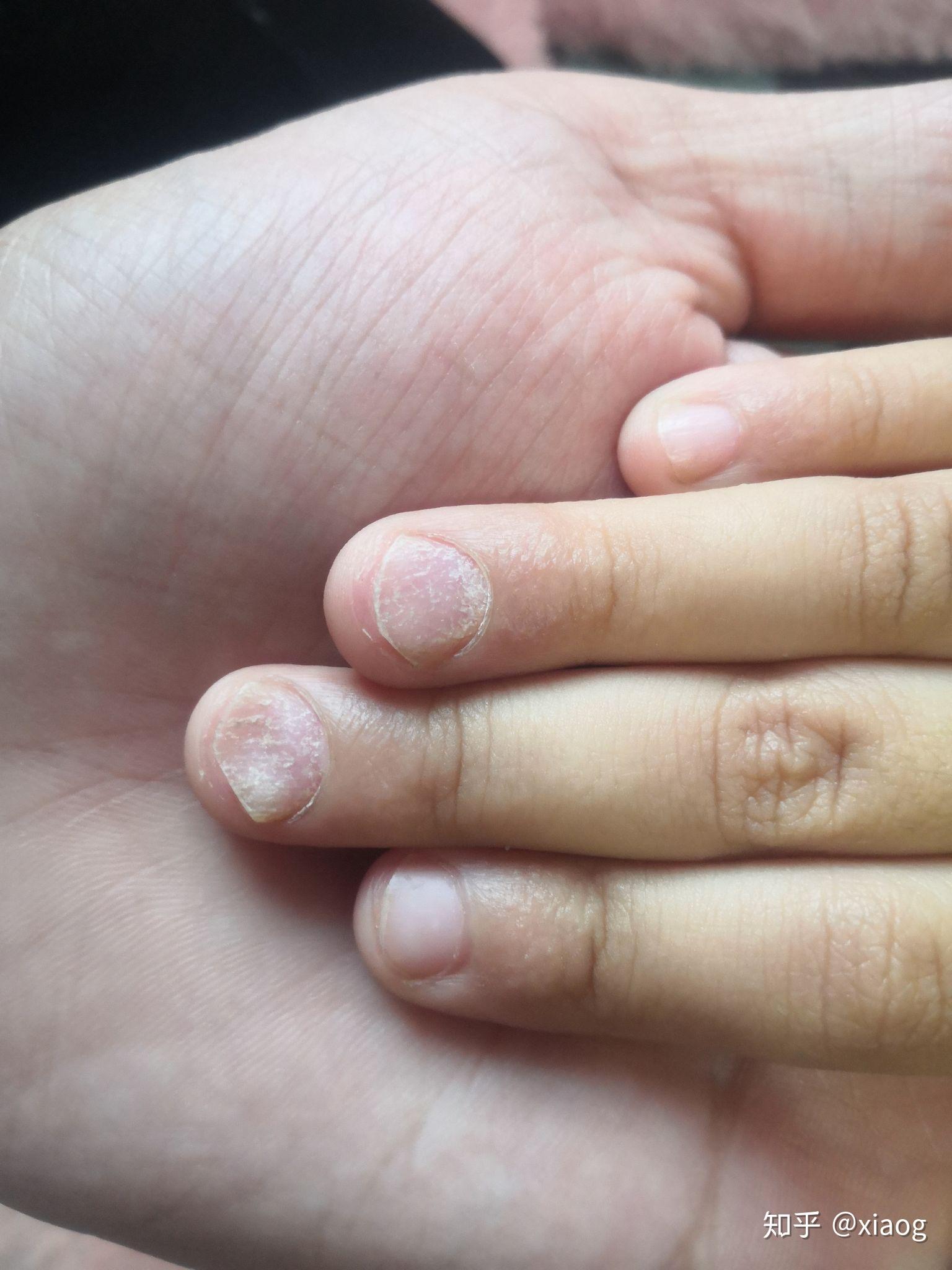 孩子抠指甲严重的图片,长期抠指甲的危害图片(3) - 伤感说说吧