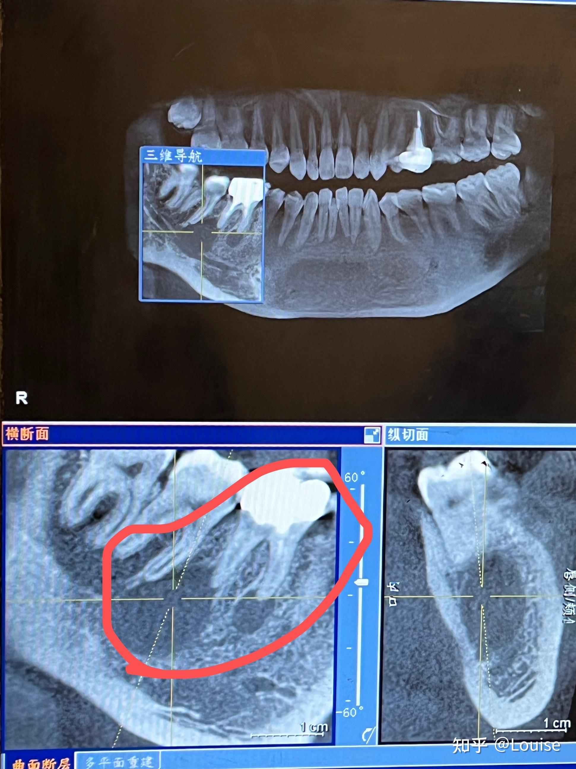 我的拔除根尖囊腫隨想