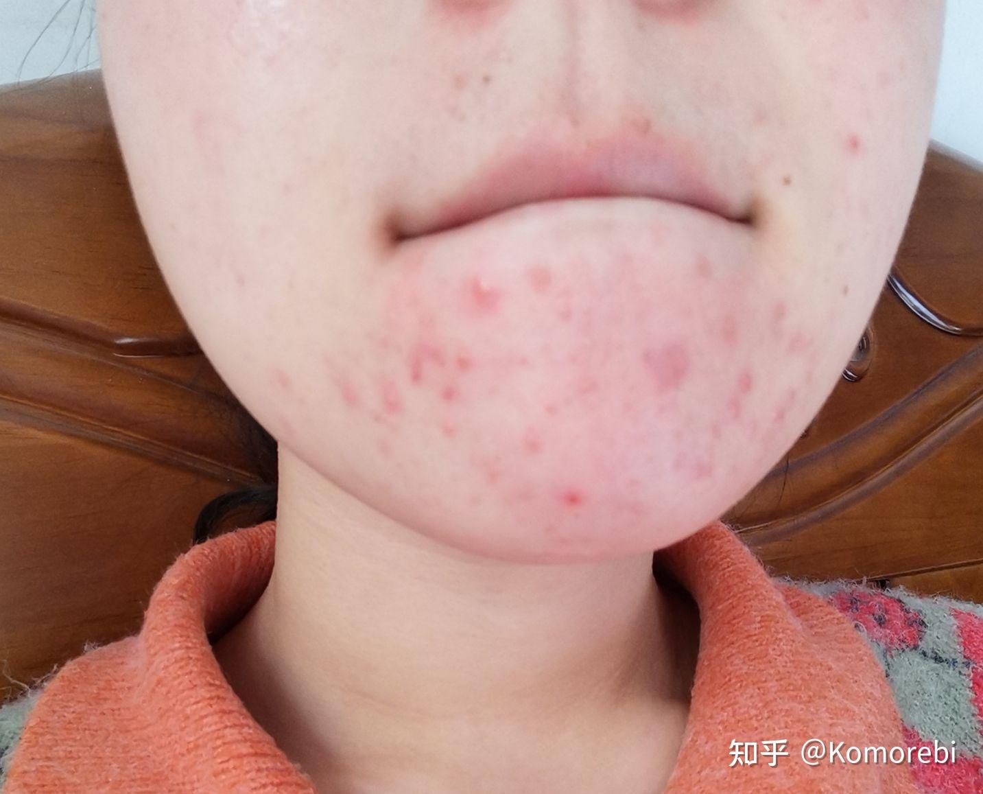 救救孩子吧阿达帕林用了一星期开始爆皮还要继续用吗 - 知乎