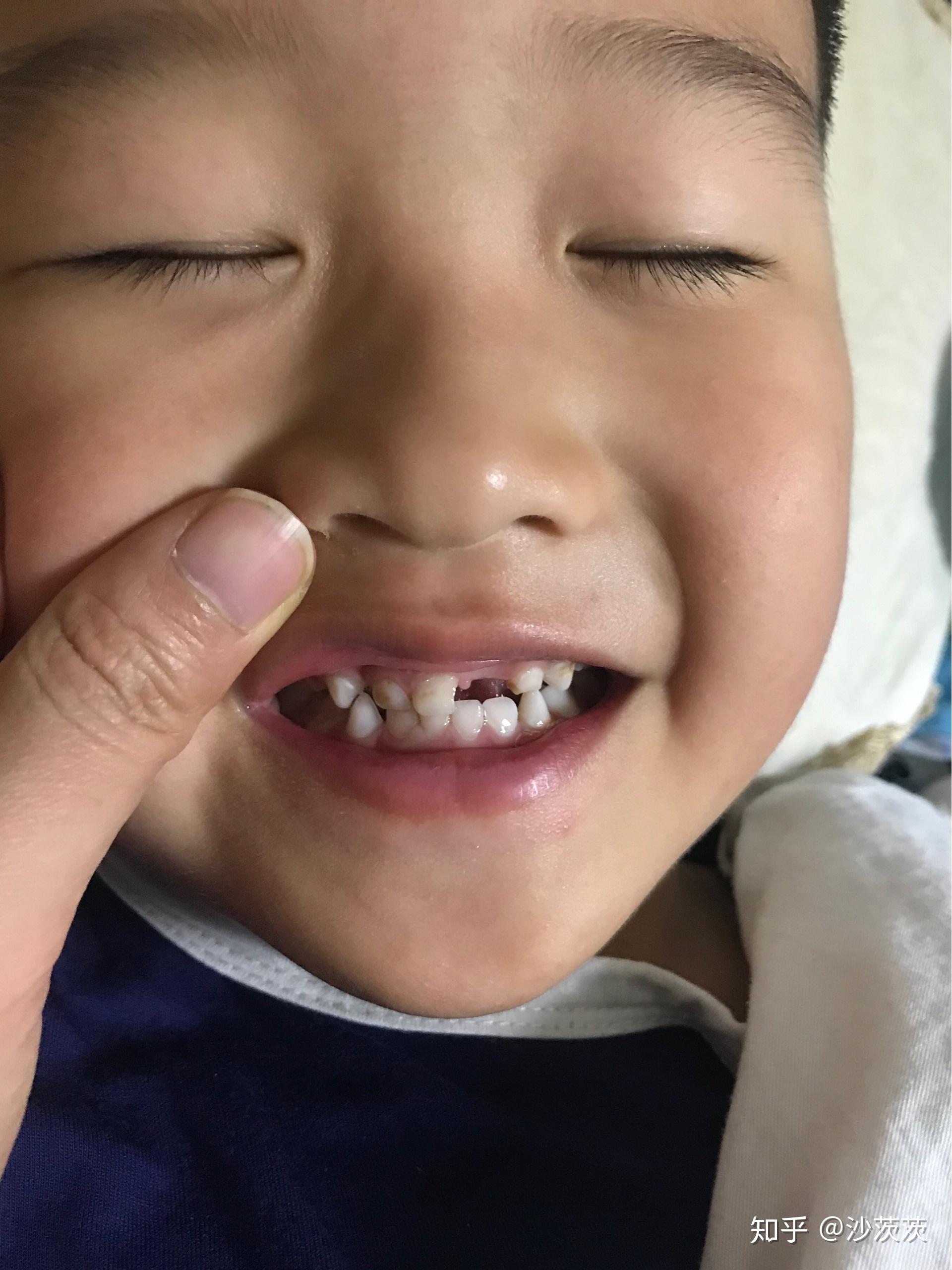 儿童前牙反颌（地包天）矫正案例分享 - 知乎
