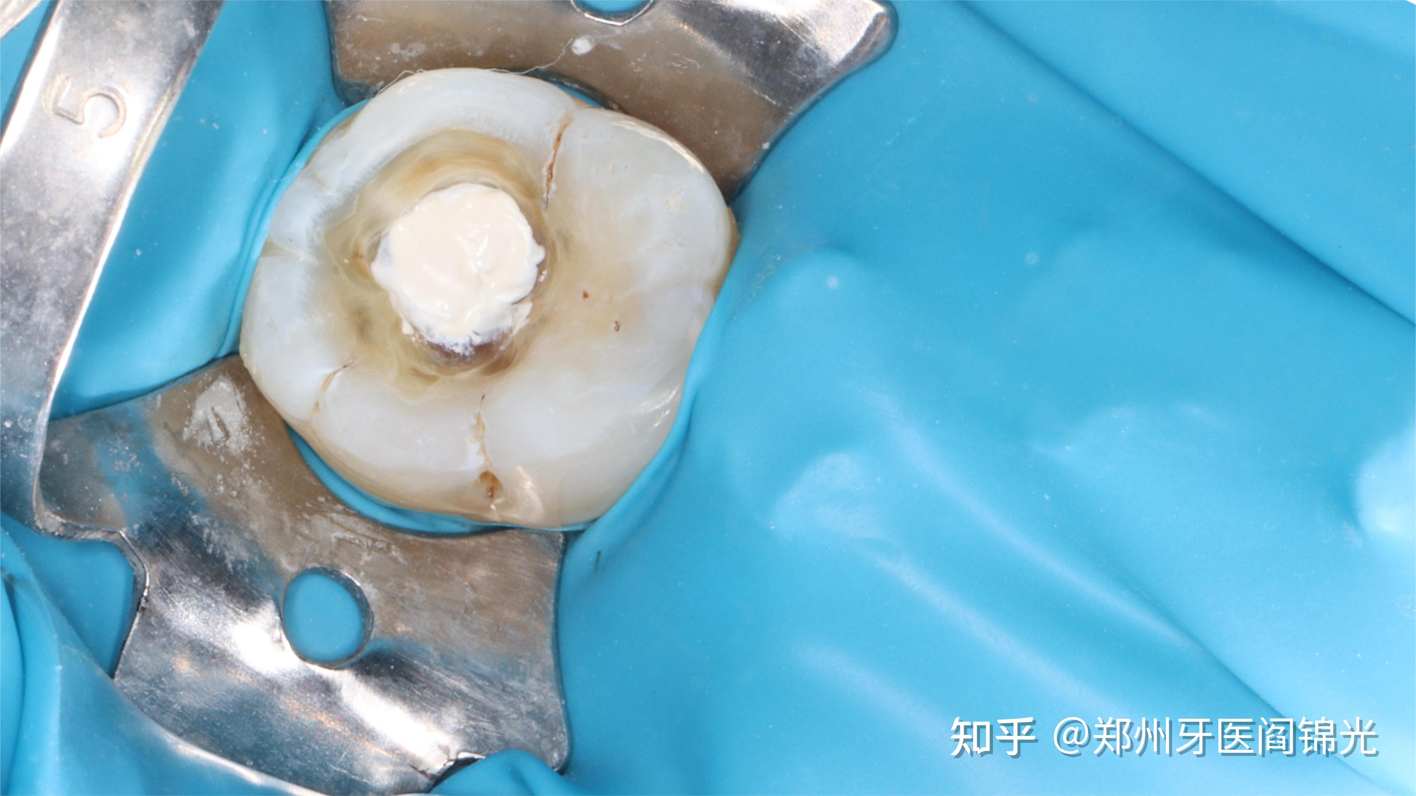 6年前银汞合金补的牙发生了继发龋，树脂再治疗 - 知乎