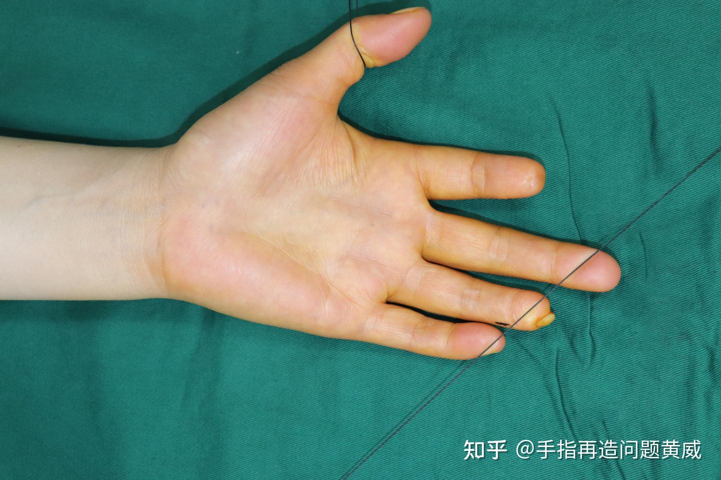所有手指缺损的情况都可以做手指再造手术吗? - 知乎