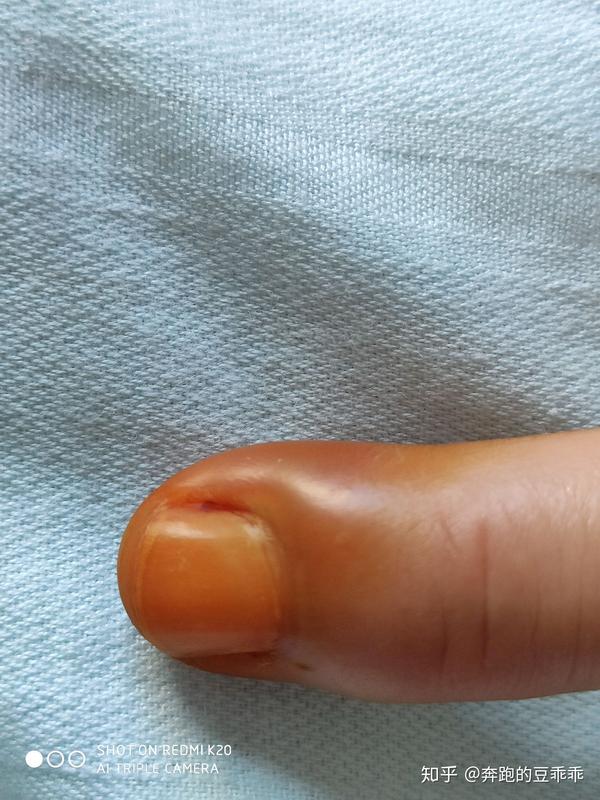 手指甲沟炎初期照片图片