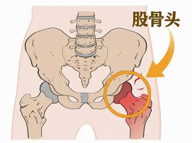 大腿根疼你怀疑过是这种疾病找上门吗