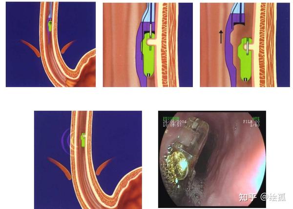 【消化系统】2.1胃食管反流病Gastroesophageal reflux disease(GERD) - 知乎