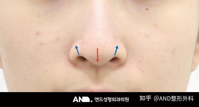 矫正龙鼻鼻孔漂亮才算完美的鼻子 [第一次鼻整形（鼻尖+鼻翼缩小+人中鼻+功能鼻）] 前后事例 知乎