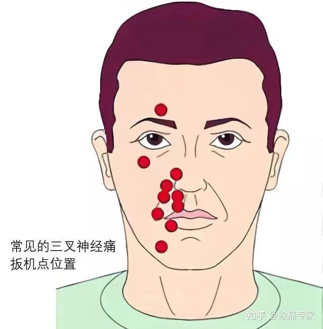 三叉神經痛為什麼被稱為天下第一痛