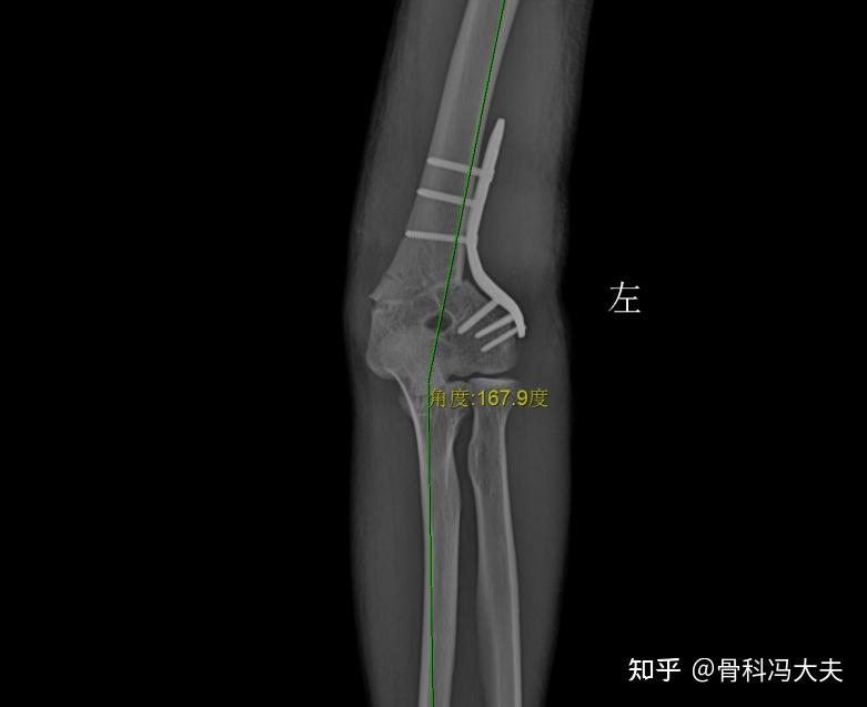 手臂畸形肘关节内翻畸形手术矫形后恢复正常外观