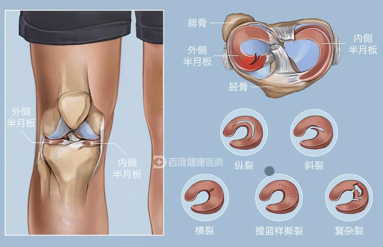 半月板手术后的图片 万图壁纸网
