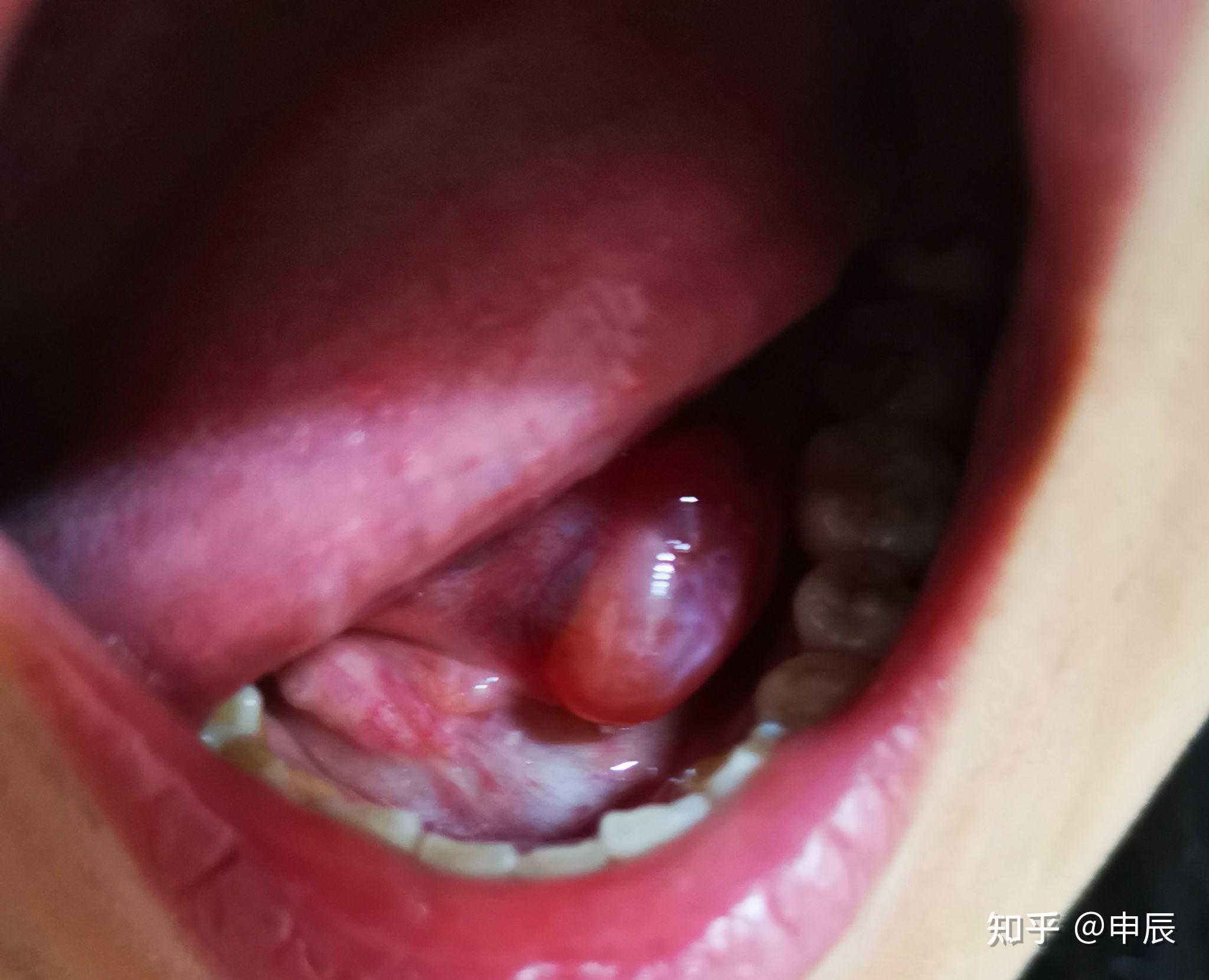 舌下腺肿大图片