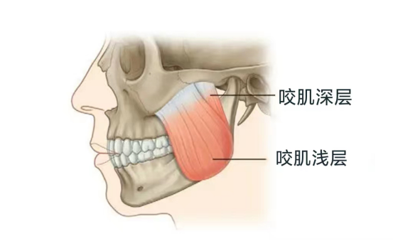 造成下颌角肥大的原因主要有骨骼宽大和咬肌肥厚
