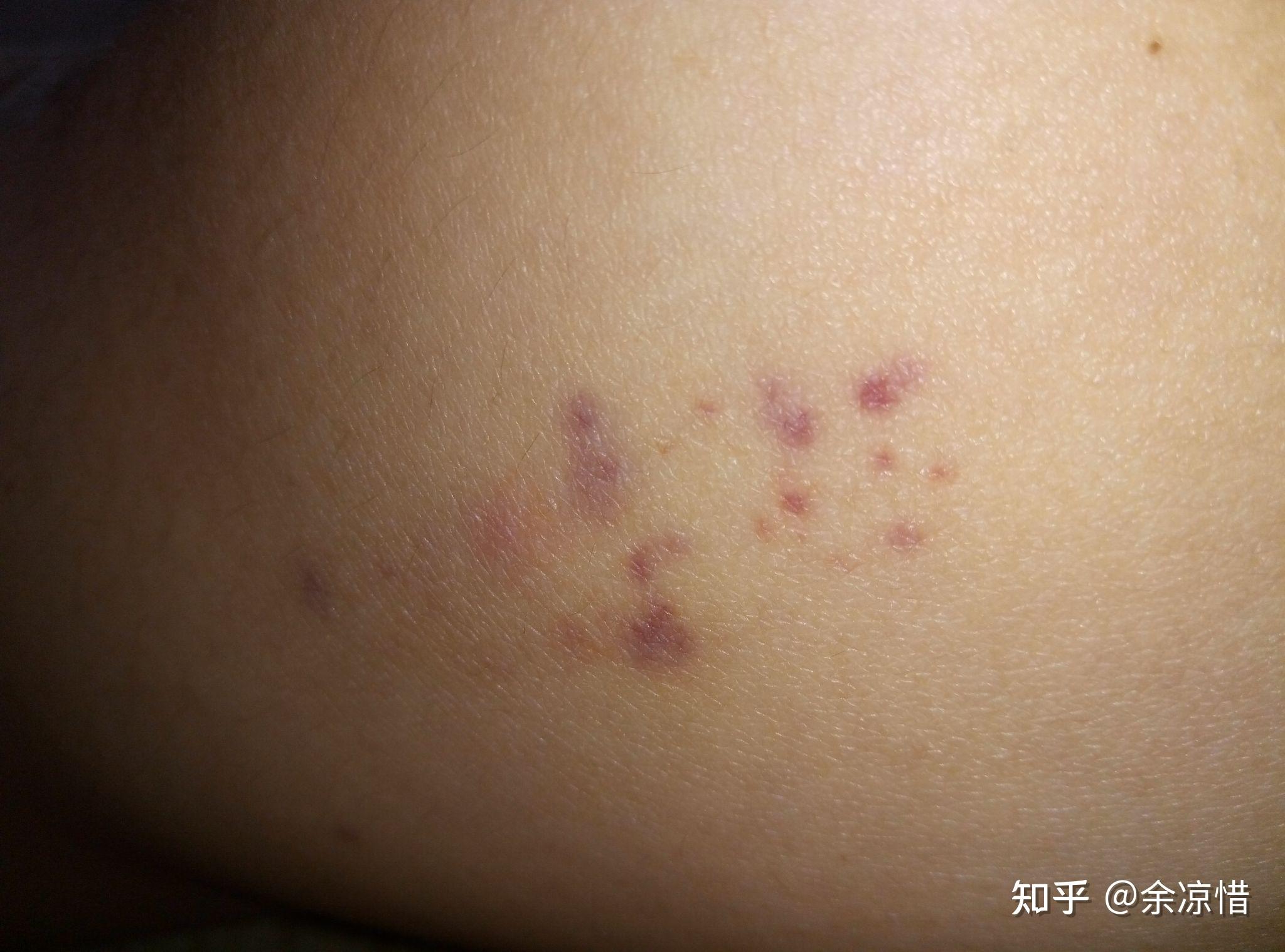 腿上无缘无故冒出些小红点,带着紫色 - 知乎
