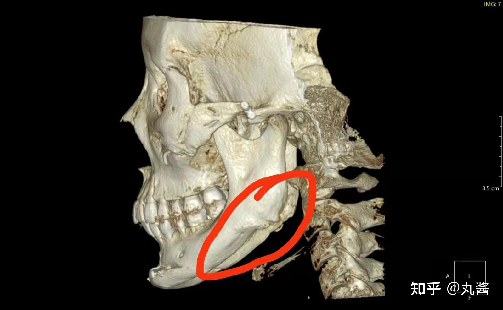 下颌骨错位图片