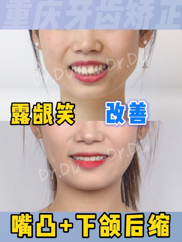 重庆牙齿矫正嘴突下颌后缩正畸案例