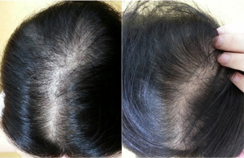 30岁女性头顶脱发5000毛移植恢复效果