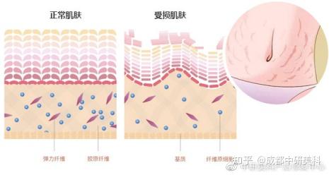 受身體激素的影響,加之腹部膨隆使身上皮膚的彈力纖維與膠原纖維損傷