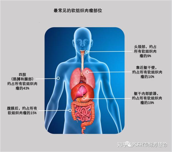 一文读懂软组织肉瘤的分类 家族遗传 患病风险 症状和体征 知乎