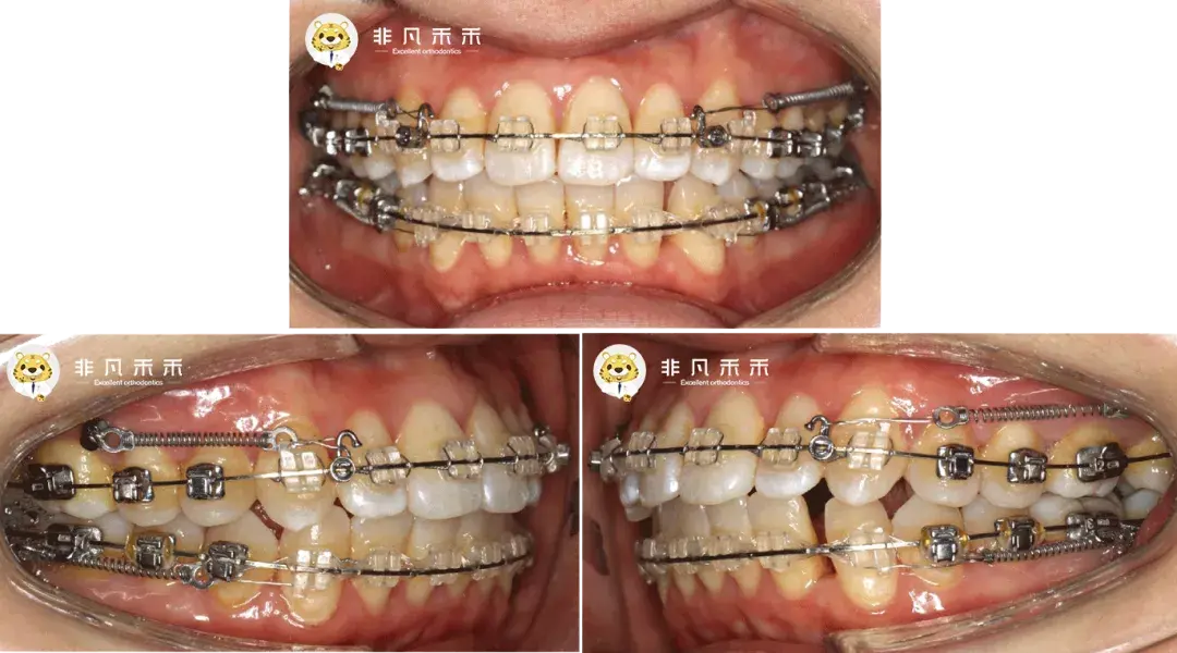 口內階段照(2019 年 01 月)治療過程23,上下頜種植支抗幫助內收