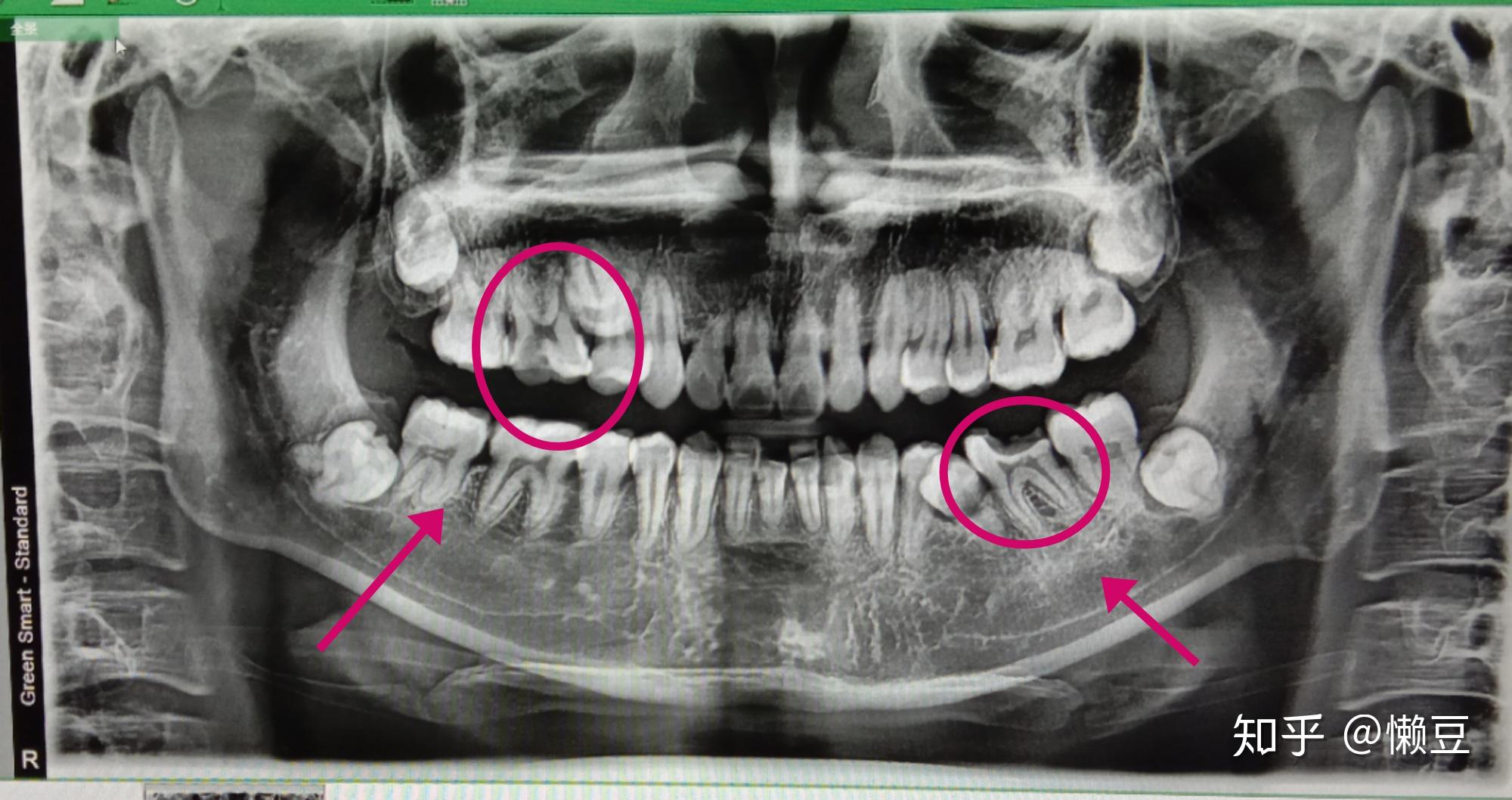 骨性凸嘴牙齿矫正记录 - 知乎
