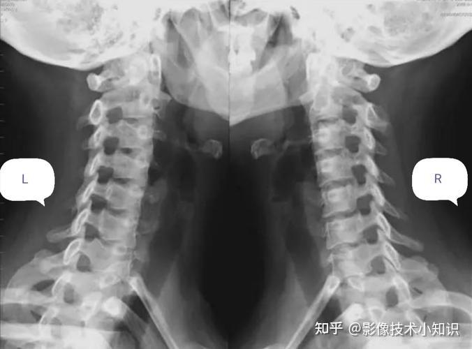 显示颈椎斜位影像,1～7颈椎显示于图像正中.2.