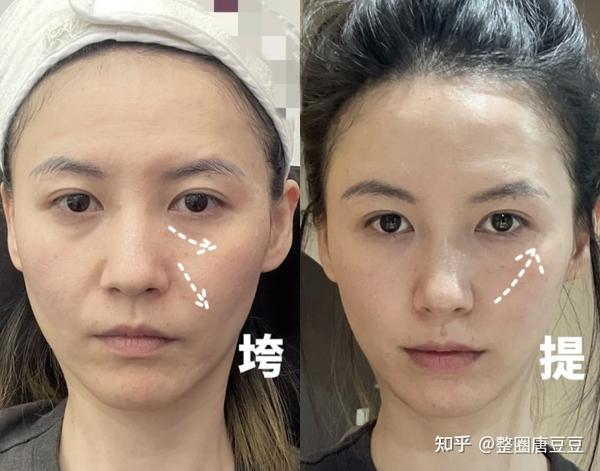25+、30+、40+岁分别适合做什么抗衰项目？这篇文章给你说清楚了！超全干货 - 知乎