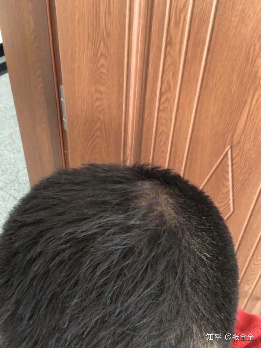 滚针治疗脱发 - 知乎