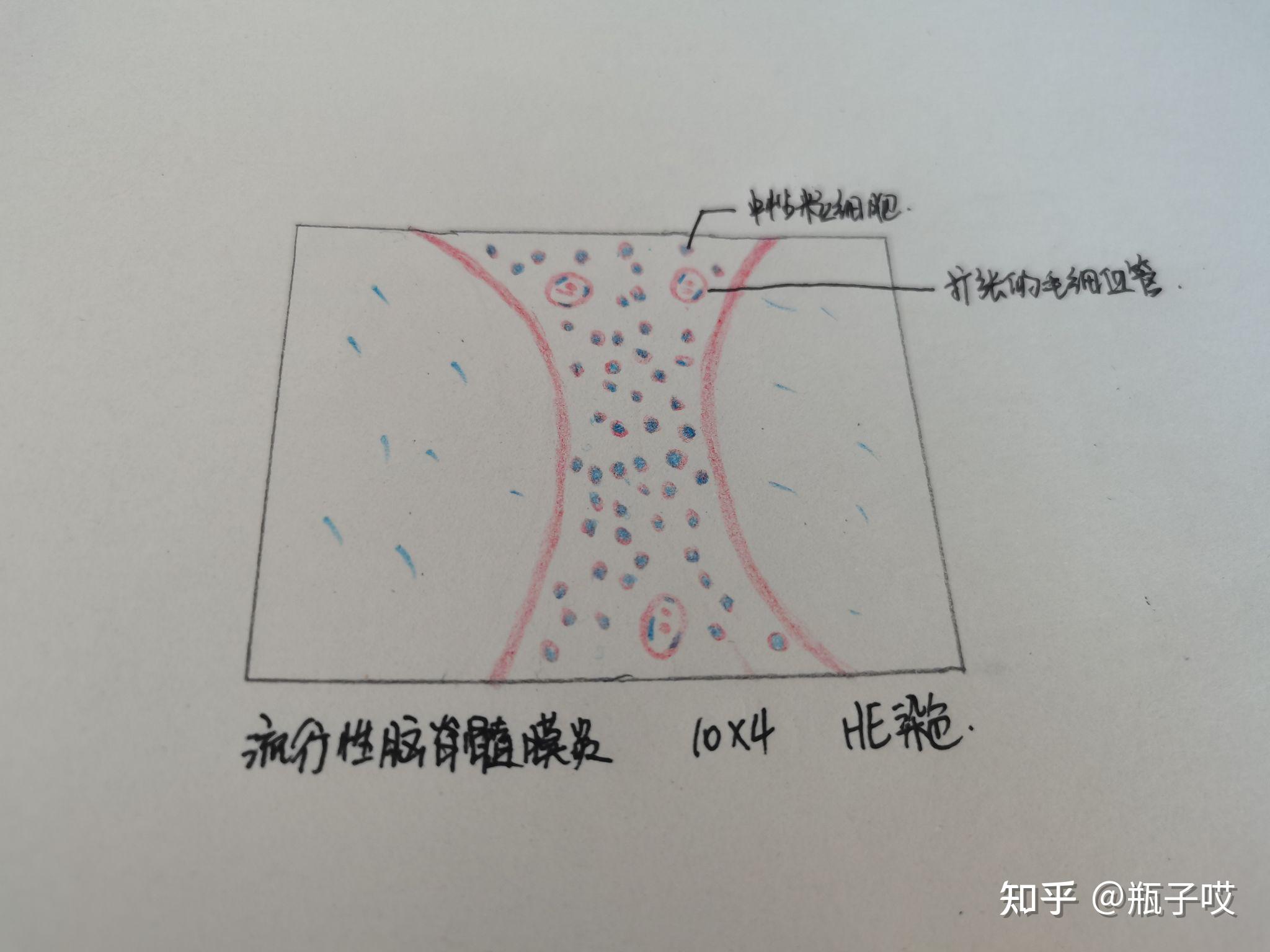 流行性脑脊髓膜炎病理红蓝铅笔绘图
