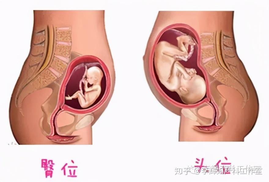 臀位虽然不是绝对的手术指征,但是胎儿窒息和脑损伤的风险很大