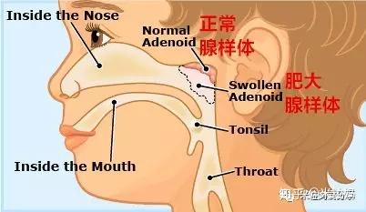 从上图可以看到,腺样体处于鼻腔,咽鼓管,咽腔共同的引流区域,所以
