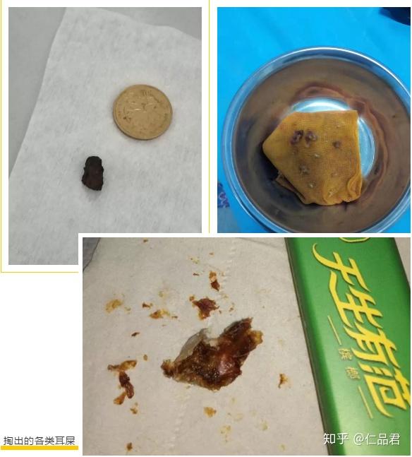 需要注意的是,无论耵聍是干性还是湿性,都属于正常现象,是由遗传基因