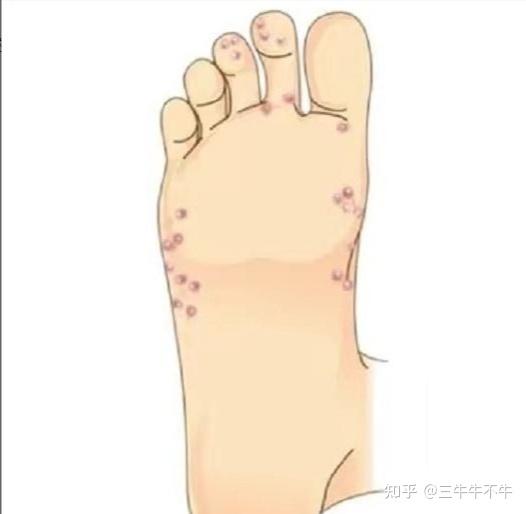 如果你脚趾糜烂严重,长期脚痒,经常起水泡脱皮,可以试试我的方法 - 知乎