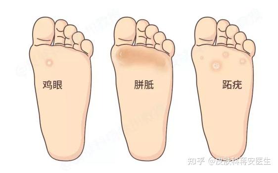 瘊子vs鸡眼,傻傻分不清楚?