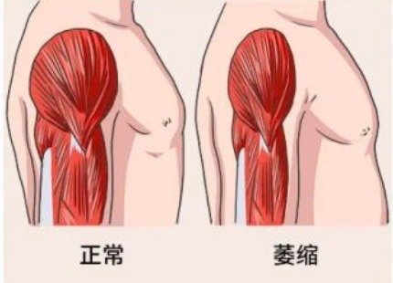 手术后肌肉萎缩怎么办 知乎