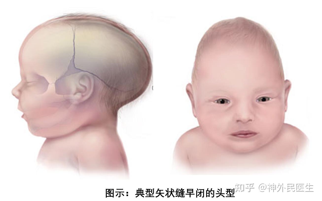 婴儿歪头症有哪些特征（宝宝头型是否正常）-幼儿百科-魔术铺