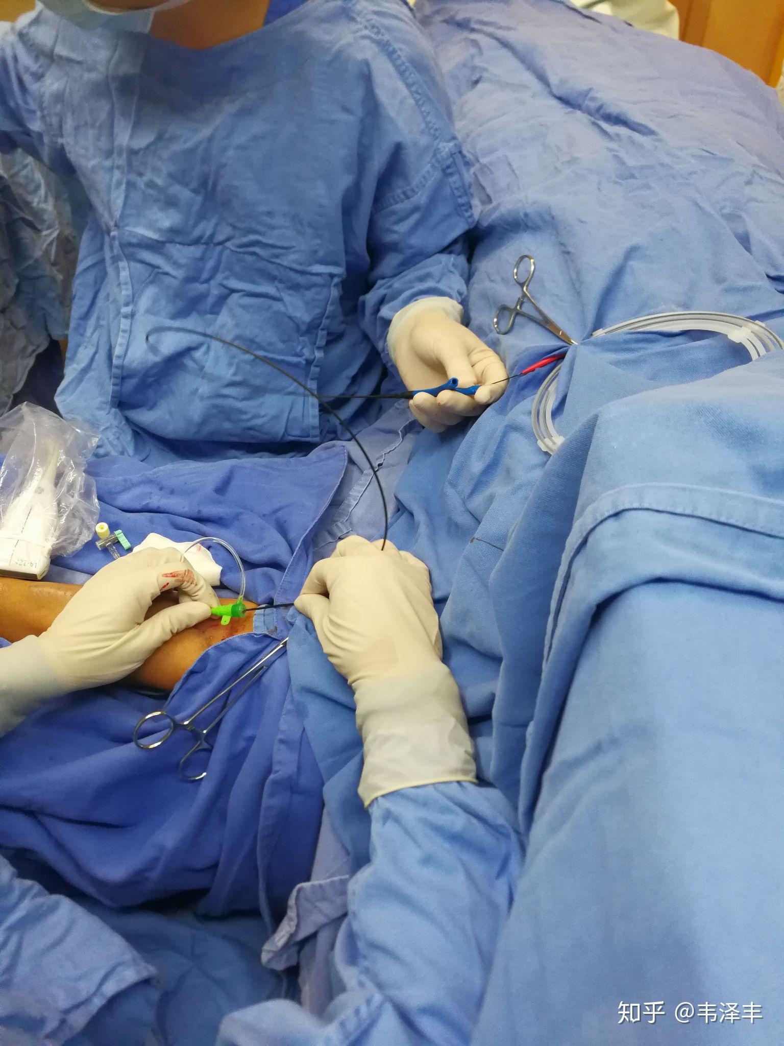 b超引导下内瘘溶栓球囊扩张术