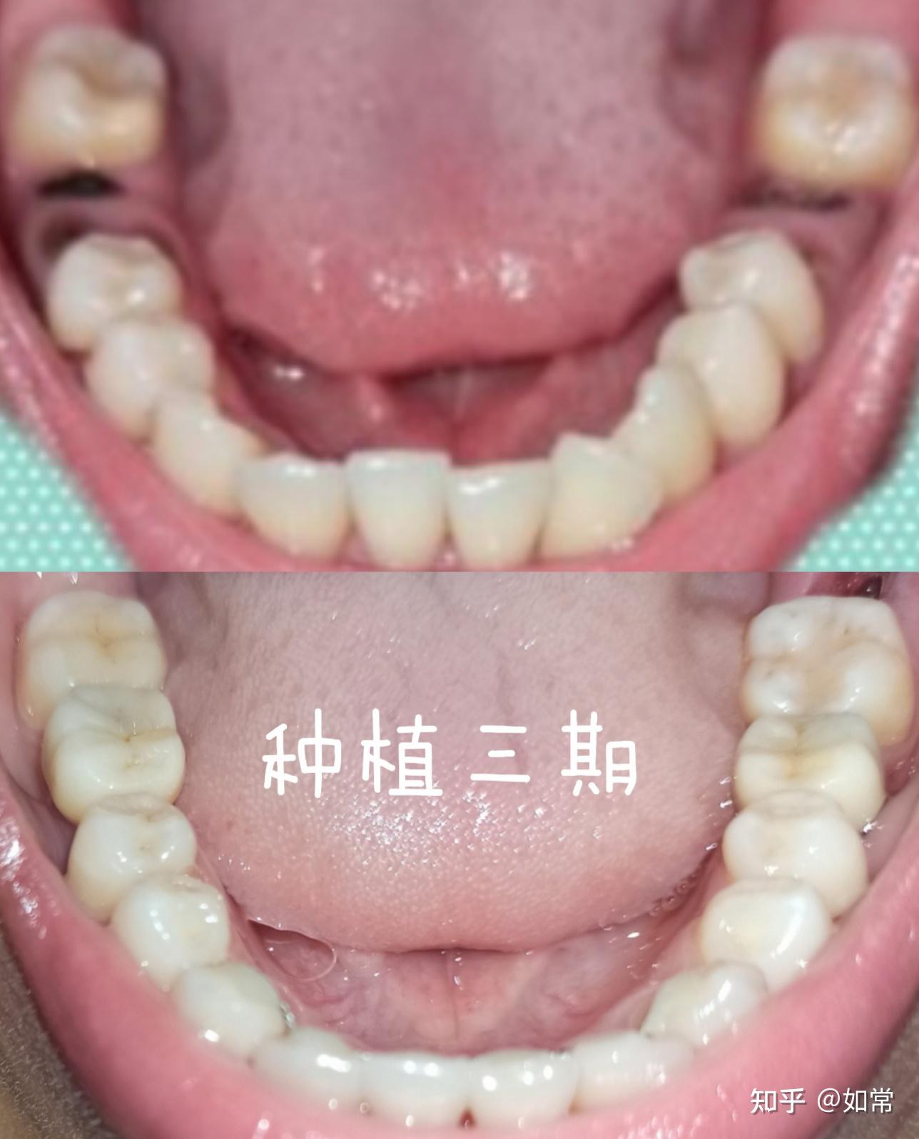 3d. 用牙齿和牙冠修复颌骨的渲染高清摄影大图-千库网
