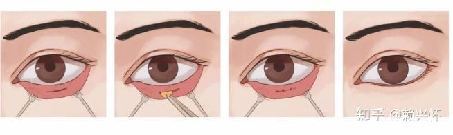 67目前只有手术这一种手段可以去掉眼袋,祛眼袋手术主要分为以下