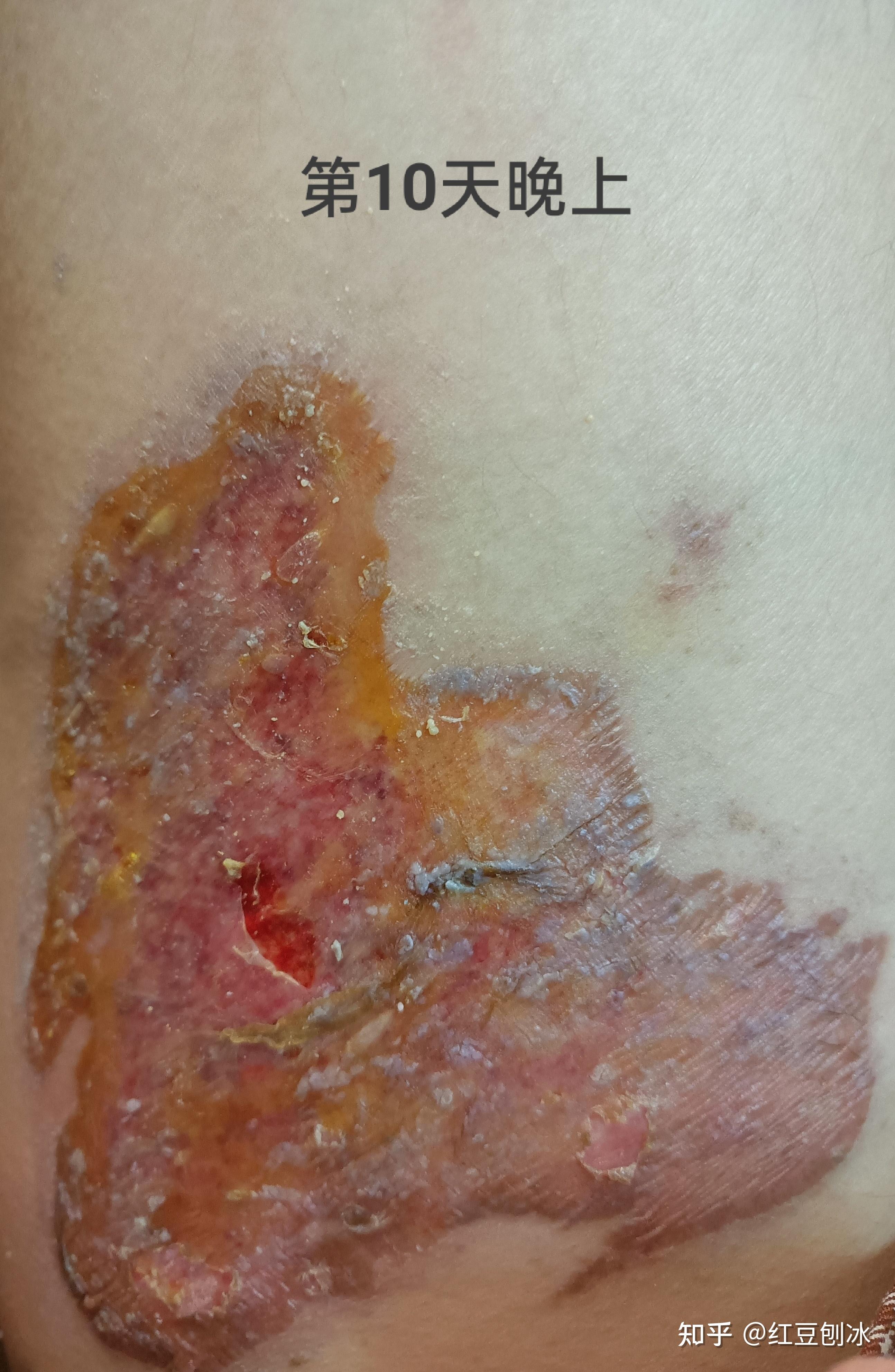 烫伤日记 - 知乎