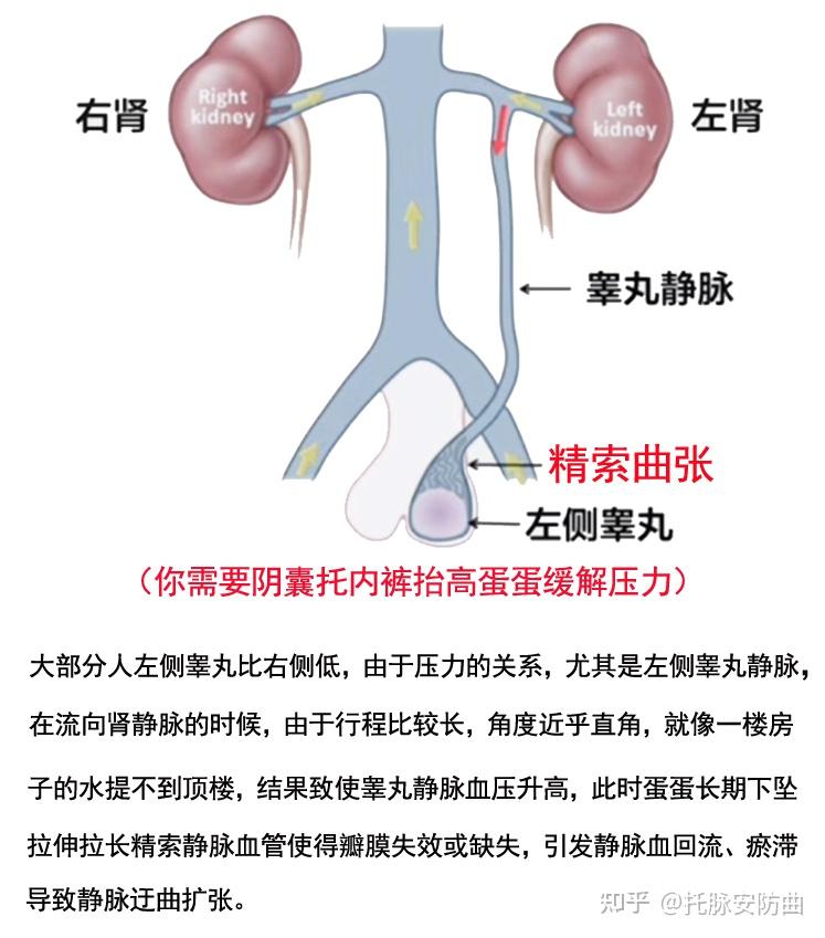 为什么会双侧精索静脉曲张? - 知乎