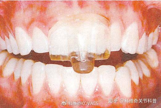 Tss Splint 速答丨你戴对咬合板了么?颞下颌关节紊乱-咬合板的类型及适应证 - 知乎