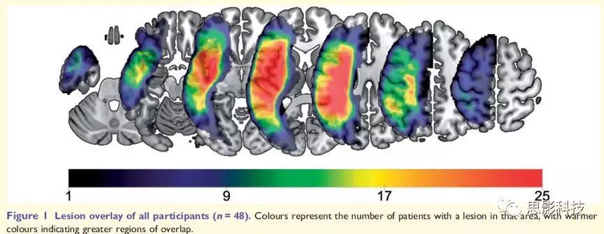 BRAIN:脑小血管病中长程白质纤维的损伤影响失语严重程度 - 知乎