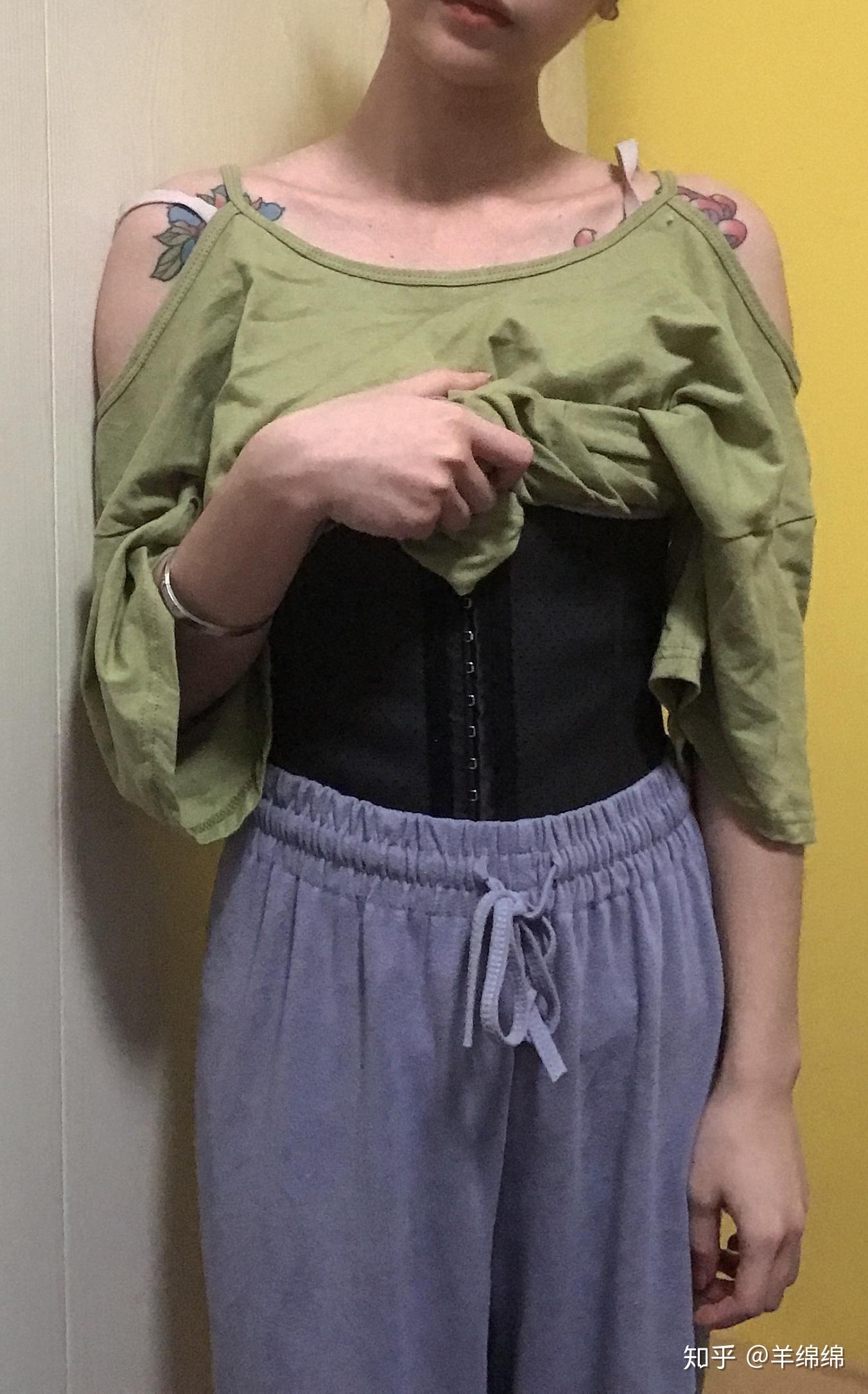 长沙腰腹吸脂真实案例分享