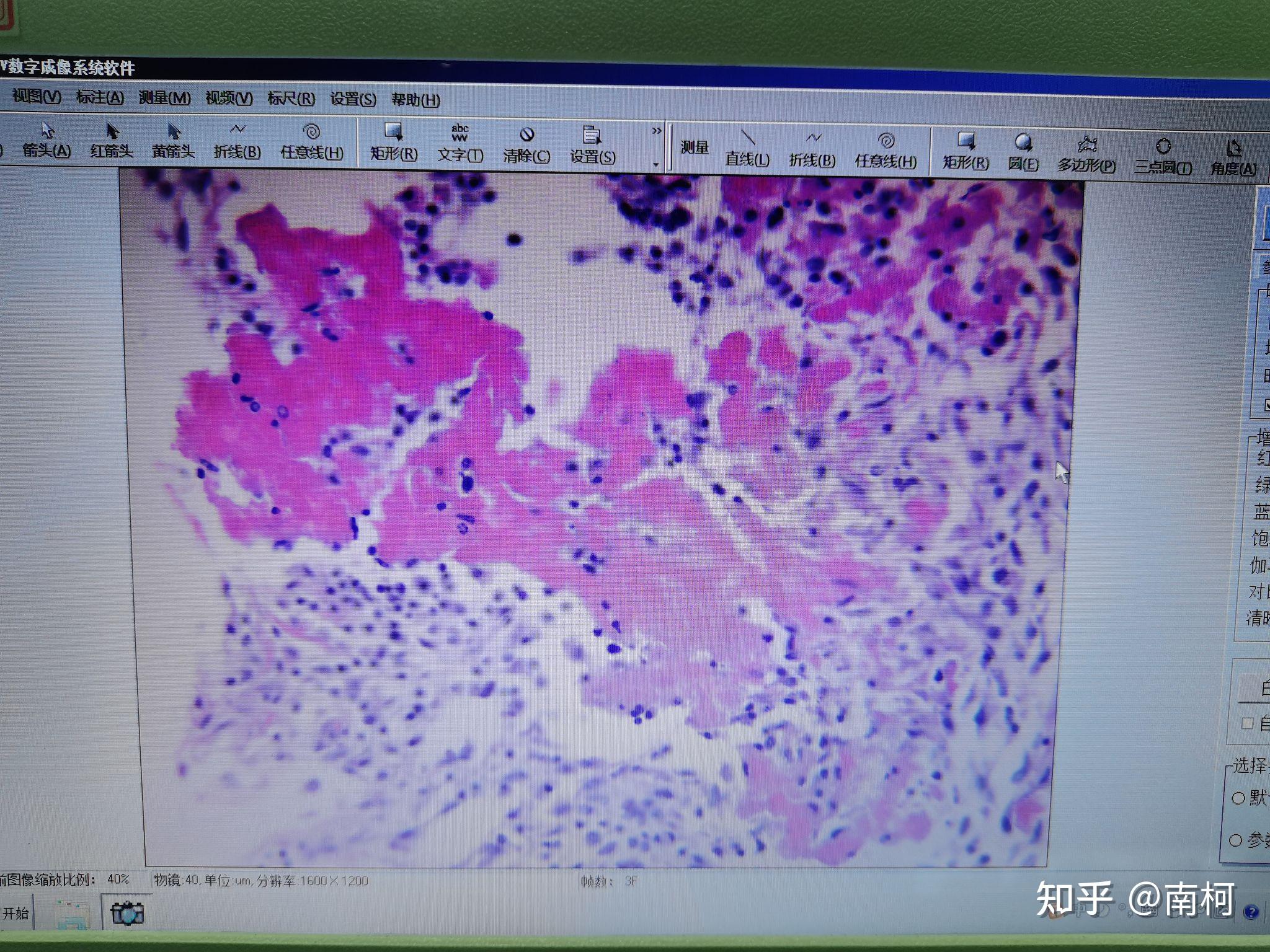 结核结节7纤维素性心包炎6阑尾蜂窝织炎慢性肺瘀血慢性肝瘀血5