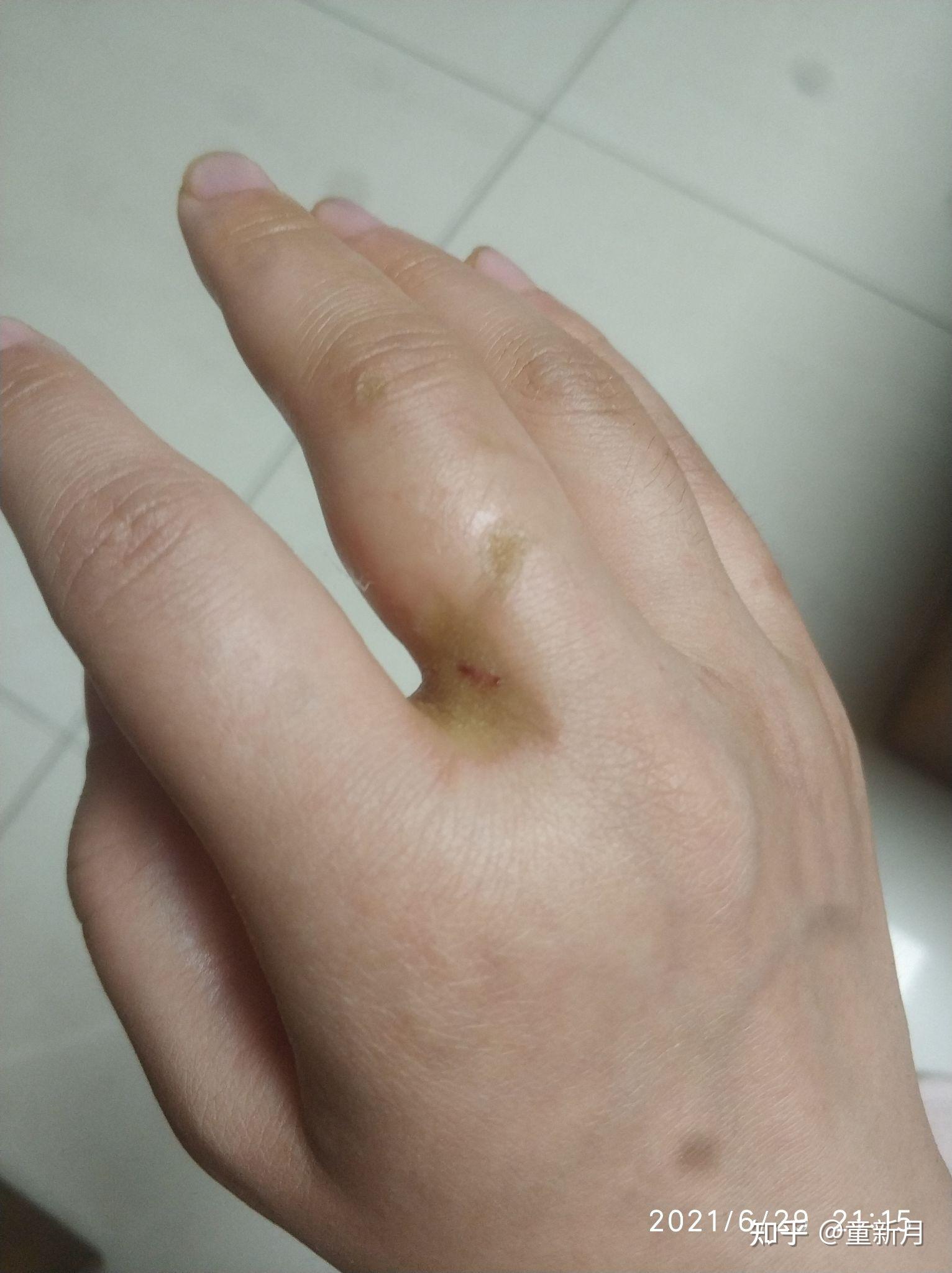 结果熬糖色的时候被溅起的糖油烫伤右手除大拇指外的四根手指,烫伤后