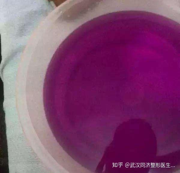 私密手术后高锰酸钾的正确使用方法