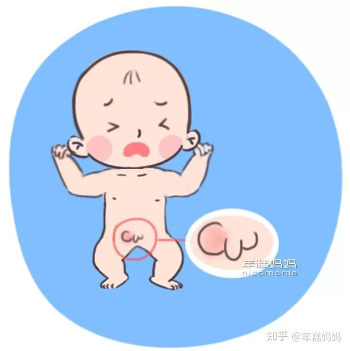 疝气在捣乱下面有请恶魔一号:鞘膜积液当宝宝腹中的液体通过腹股沟管