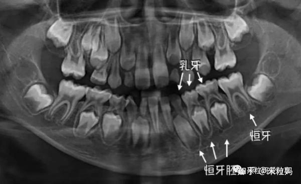 乳牙和马牙对比照图片